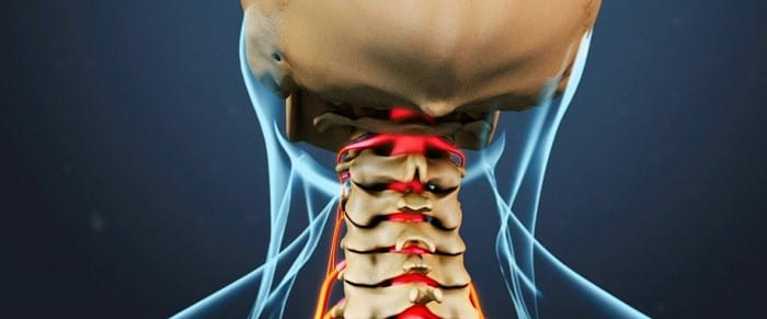 فتق دیسک گردن چیست؟ راه درمان فتق دیسک گردن بدون جراحی